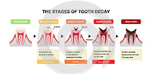 The stages of tooth decay / flat vector illustration