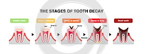 The stages of tooth decay / flat vector illustration