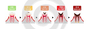 The stages of tooth decay / flat vector illustration Japanese