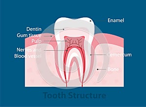 The stages of tooth decay, vector illustration