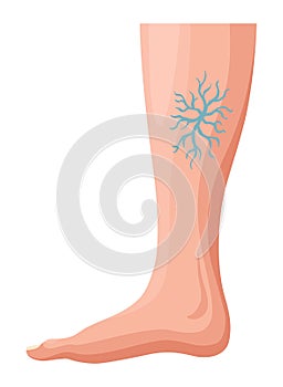 Stages or types of varicose veins development. Medical poster or disease infographic. Image of diseased legs. Vector