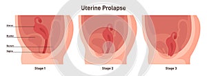 Stages of uterine prolapse. Pelvic floor muscles weakening, Support photo