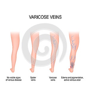 Stages of varicose veins.