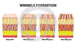 Stages of wrinkles at different ages. Anatomical structure of the skin. Elastin, Hyaluronic acid, Collagen. Infographics photo