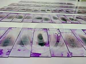 Stained glass slides of peripheral blood smear with violet Leishman giemsa stain is isolated in hematology department