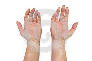 Stains from vitiligo disease on the inside of the hands and forearms of a young Caucasian woman, isolated on a white background w