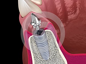 Standard abutment, dental implant and ceramic crown. Medically accurate tooth 3D illustration photo