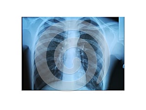 Standard panoramic X-ray of the chest - a healthy heart and lungs