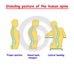 Standing posture of the human spine. Defects of the human spine. Correct alignment of human body in standing posture. vector illus photo