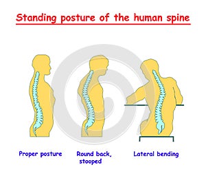 Standing posture of the human spine. Defects of the human spine. Correct alignment of human body in standing posture. vector illus