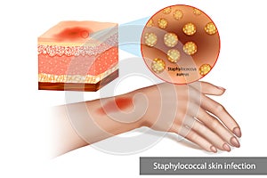 Staphylococcal skin infection or Staph infection. Superimposed bacterial infection Skin cellulitis.
