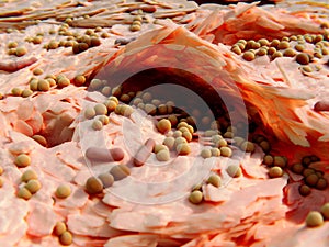 Staphylococcus aureus bacteria aggravete neurodermitis symptons