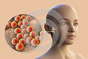 Staphylococcus aureus bacterium as a cause of otitis media