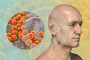 Staphylococcus aureus bacterium as a cause of otitis media photo