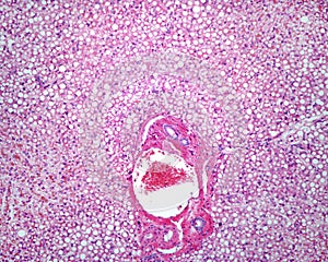 Steatosis. Human fatty liver