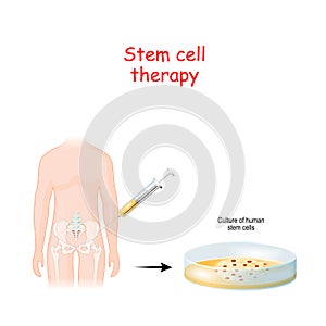 Stem cell therapy