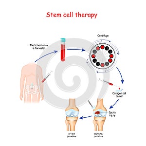 Stem cell therapy. Before and after of Sports injury