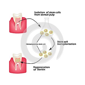 Stem cells from the dentin of the tooth is used to regenerate diseased tooth dentin. Infographics. Vector illustration