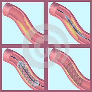 Stening of blood vessels and veins. Restoration of blood flow.