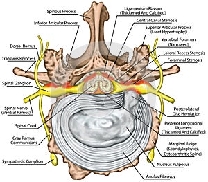 BOARD Stenosis, lumbar disk herniation photo