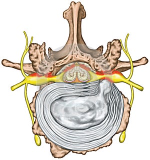Stenosis, lumbar disk herniation photo
