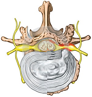 Stenosis, lumbar disk herniation VS good vertebra