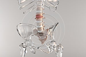 Stenosis of the lumbar spine photo