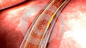 Stent