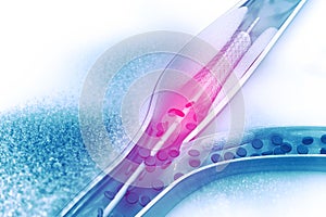 Stent angioplasty