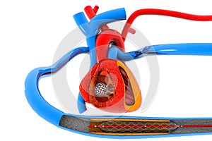 Stent angioplasty