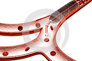 Stent angioplasty