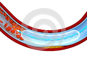 Stent angioplasty