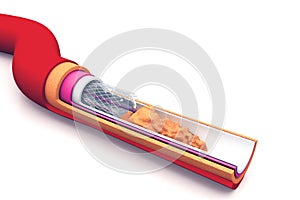 Stent angioplasty