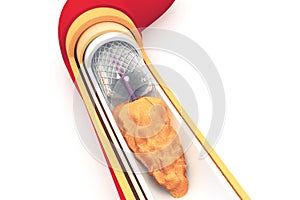 Stent angioplasty