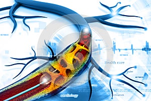 Stent angioplasty