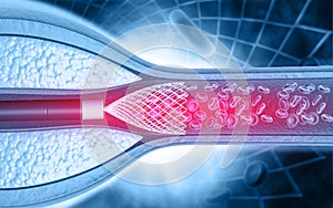 Stent angioplasty on science background