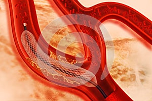 Stent angioplasty on scientific background