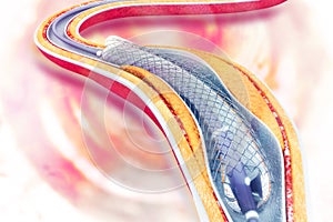 Stent angioplasty on scientific background