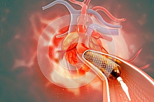 Stent angioplasty on scientific background