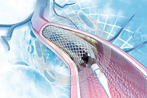 Stent angioplasty on scientific background