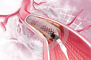 Stent angioplasty on scientific background