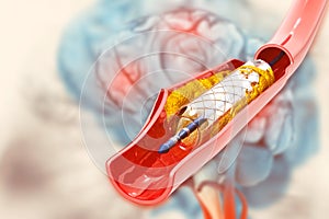 Stent angioplasty on scientific background