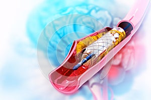 Stent angioplasty on scientific background