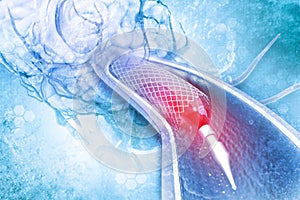 Stent angioplasty on scientific background