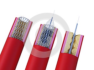 A stent being placed