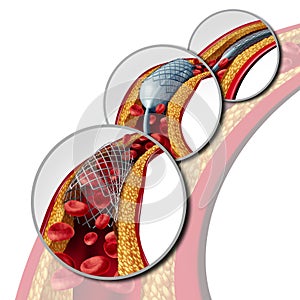 Stent Coronary Medical Concept