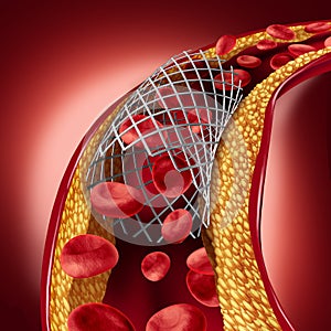 Stent Implant Concept