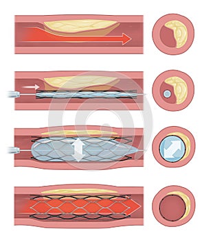 stent implantation