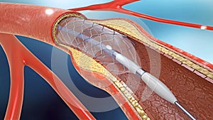 Stent implantation for supporting blood circulation into blood vessels