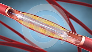 Stent implantation for supporting blood circulation into blood vessels - 3d illustration